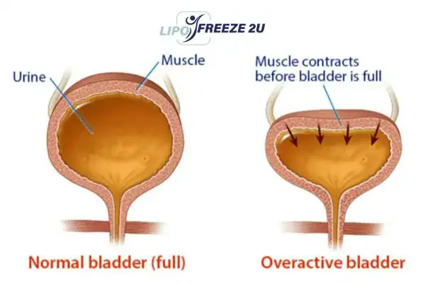diagram of overactive bladder treatment Rainham