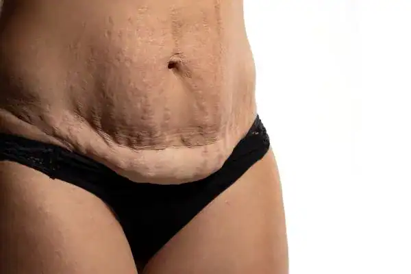 loose skin after weight loss injections Rainham