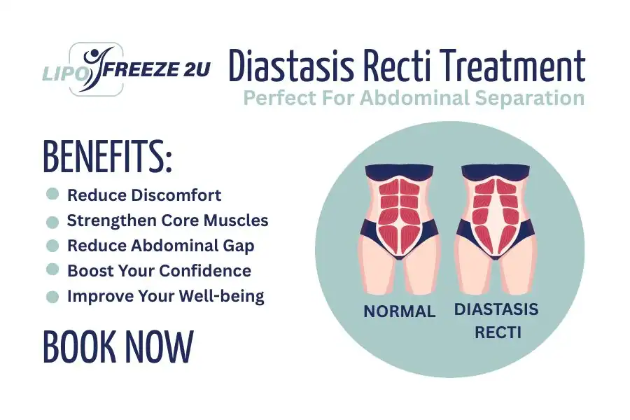 Benefits of body toning treatment Rainham for Diastasis recti