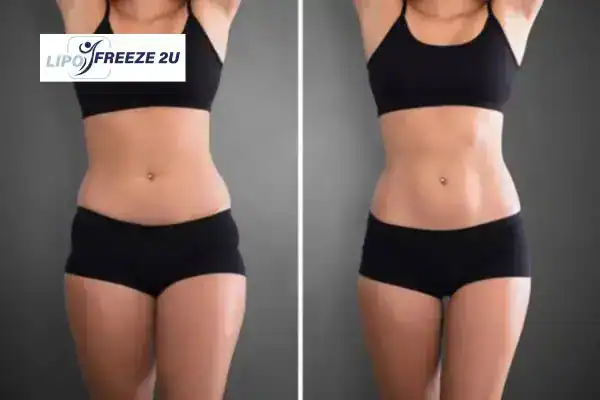 How Can LIPO FREEZE 2U Support Your Post-Pregnancy Body Recovery Rainham?