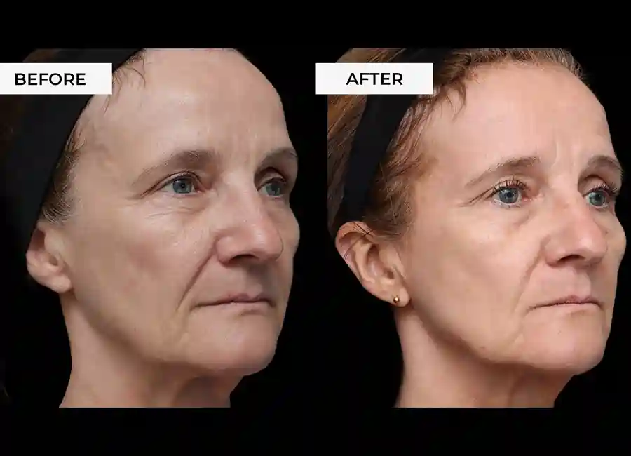How Many RF Microneedling Sessions Will You Need to See a Difference Rainham?