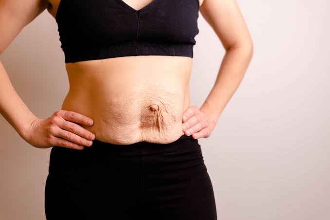 Is Surgery Really the Only Way to Repair Diastasis Recti Rainham?