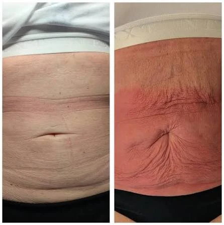 How Does RF Microneedling Improve Crepey, Thin and Uneven Skin Texture Rainham?