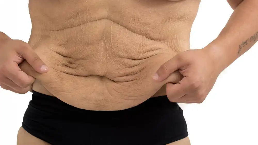 Why Does Weight Loss Medication Leave Some People With Loose or Sagging Skin Rainham?